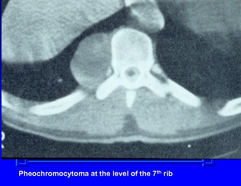 Pheochromocytoma at the level of the 7 th rib 