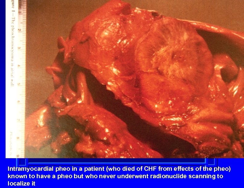 Intramyocardial pheo in a patient (who died of CHF from effects of the pheo)