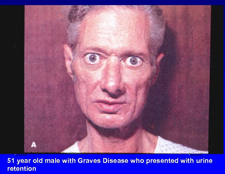 51 year old male with Graves Disease who presented with urine retention 