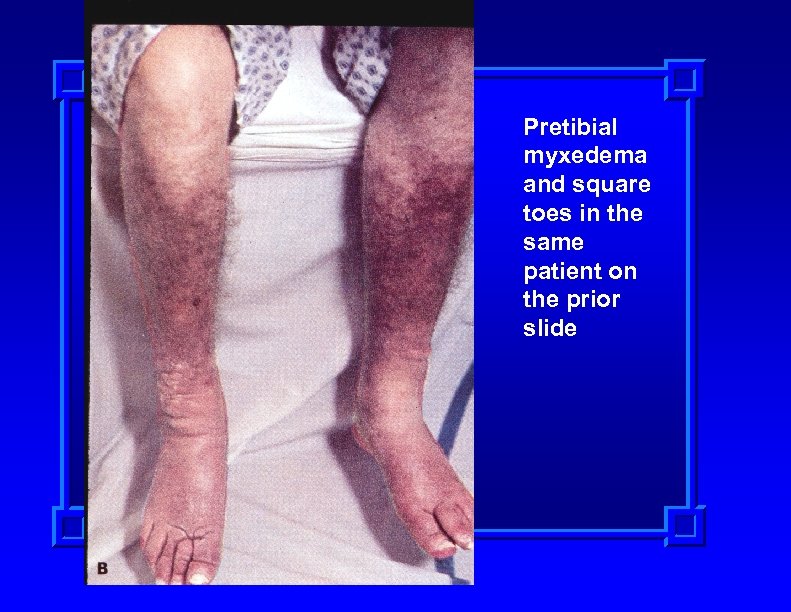 Pretibial myxedema and square toes in the same patient on the prior slide 