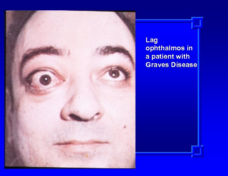Lag ophthalmos in a patient with Graves Disease 