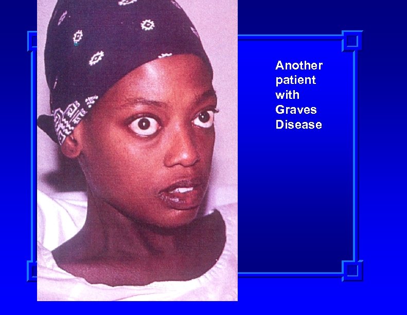 Another patient with Graves Disease 