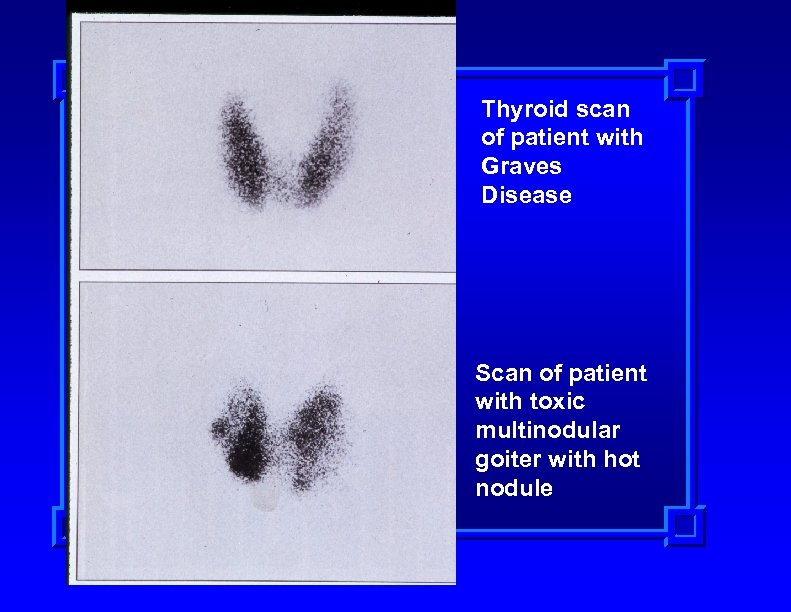 Thyroid scan of patient with Graves Disease Scan of patient with toxic multinodular goiter