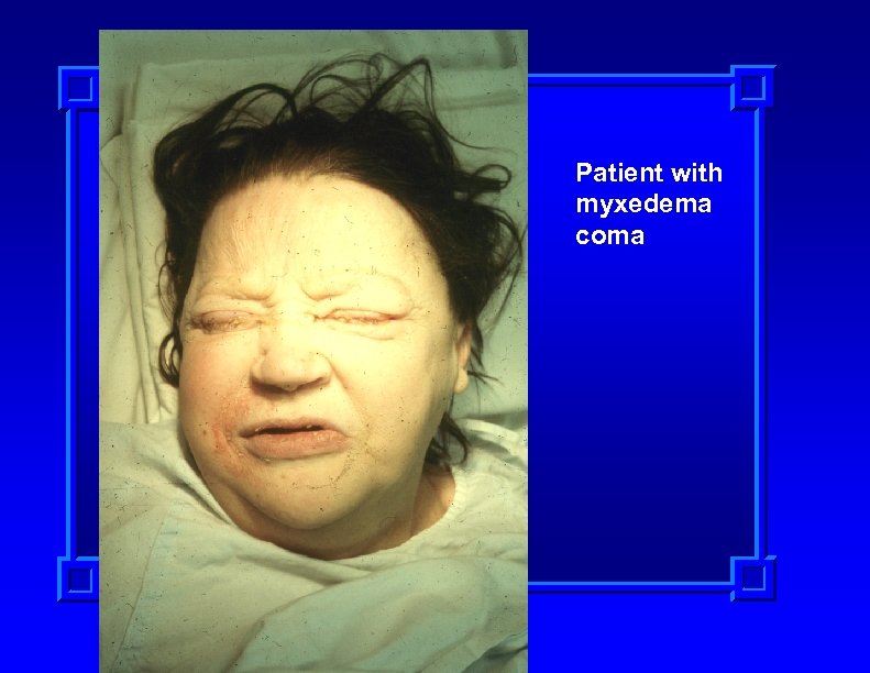 Patient with myxedema coma 