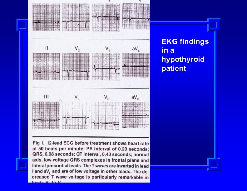 EKG findings in a hypothyroid patient 