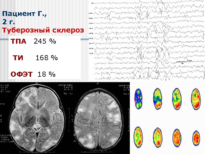 Пациент Г. , 2 г. Туберозный склероз ТПА 245 % ТИ 168 % ОФЭТ