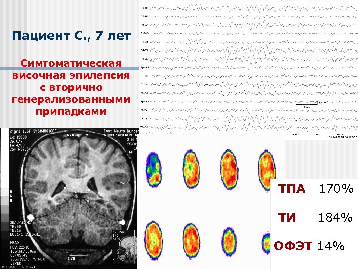 Пациент С. , 7 лет Симтоматическая височная эпилепсия с вторично генерализованными припадками ТПА 170%