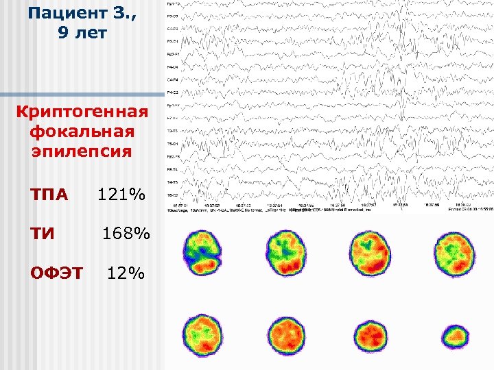 Пациент З. , 9 лет Криптогенная фокальная эпилепсия ТПА 121% ТИ 168% ОФЭТ 12%