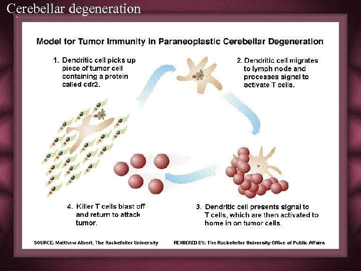 Cerebellar degeneration 