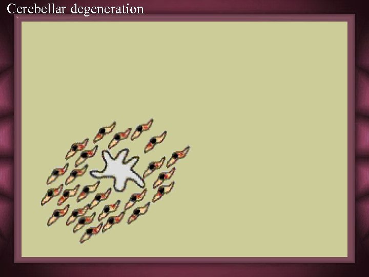 Cerebellar degeneration 