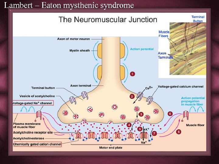 Lambert – Eaton mysthenic syndrome 