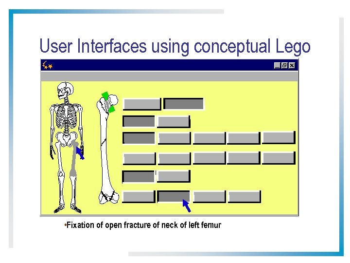 User Interfaces using conceptual Lego • Fixation of open fracture of neck of left