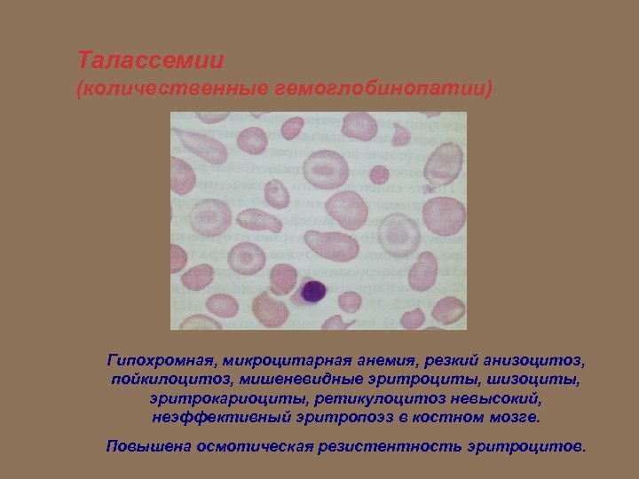 Пойкилоцитоз анемия. Пойкилоцитоз анизоцитоз анемия. Микроцитоз анизоцитоз пойкилоцитоз. Пойкилоцитоз при анемии.