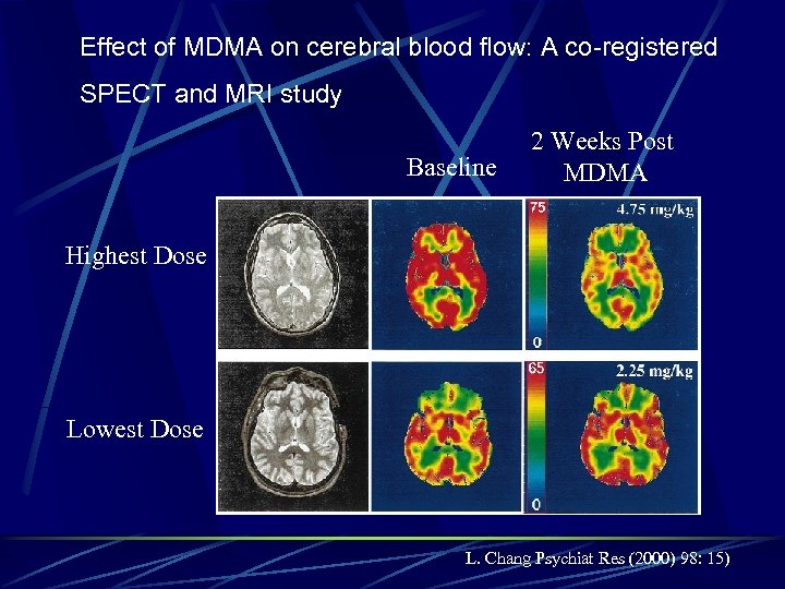 Effect of MDMA on cerebral blood flow: A co-registered SPECT and MRI study Baseline