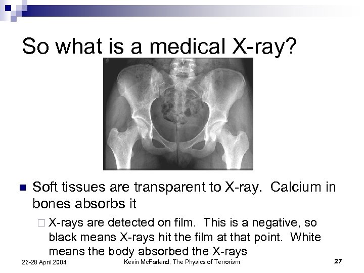 So what is a medical X-ray? n Soft tissues are transparent to X-ray. Calcium