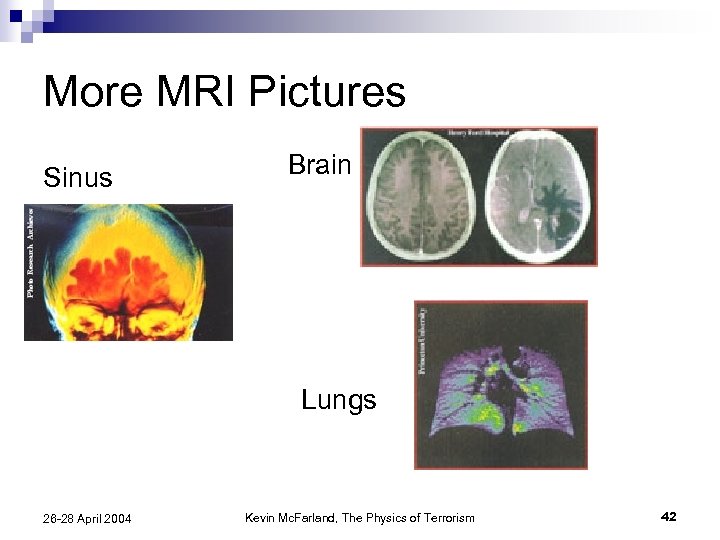 More MRI Pictures Sinus Brain Lungs 26 -28 April 2004 Kevin Mc. Farland, The