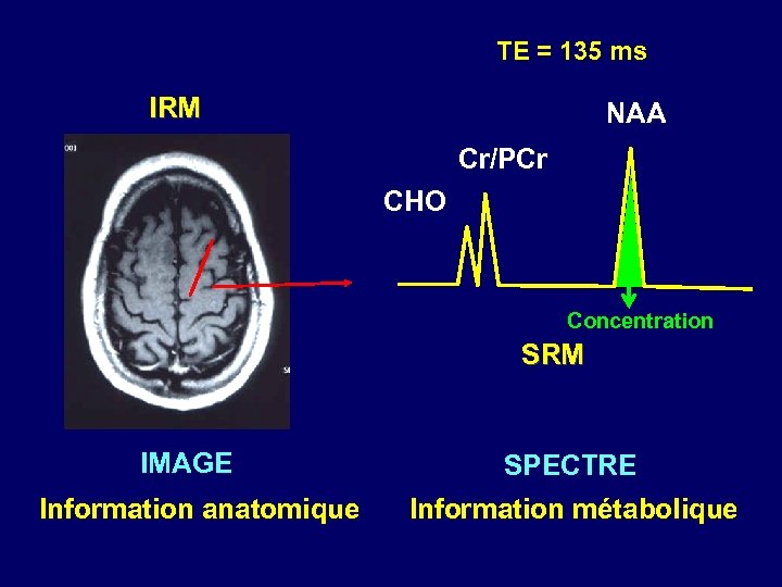 TE = 135 ms IRM NAA Cr/PCr CHO Concentration SRM IMAGE Information anatomique SPECTRE