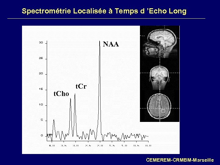 Spectrométrie Localisée à Temps d ’Echo Long NAA t. Cho t. Cr CEMEREM-CRMBM-Marseille 