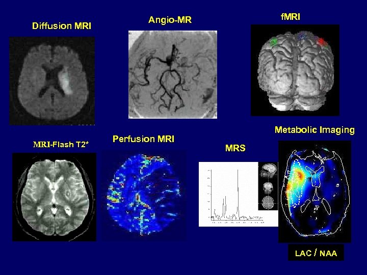 Diffusion MRI-Flash T 2* f. MRI Angio-MR Perfusion MRI Metabolic Imaging MRS LAC /