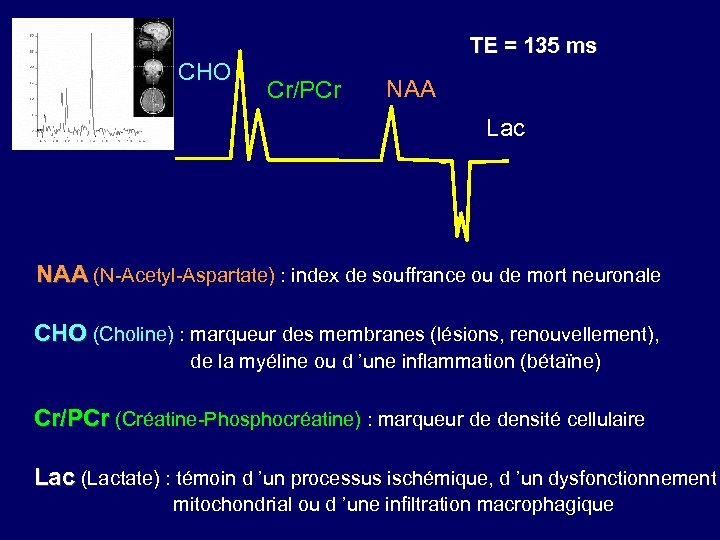 TE = 135 ms CHO Cr/PCr NAA Lac NAA (N-Acetyl-Aspartate) : index de souffrance