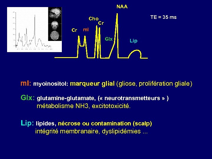 NAA Cr TE = 35 ms Cho Cr m. I Glx Lip m. I: