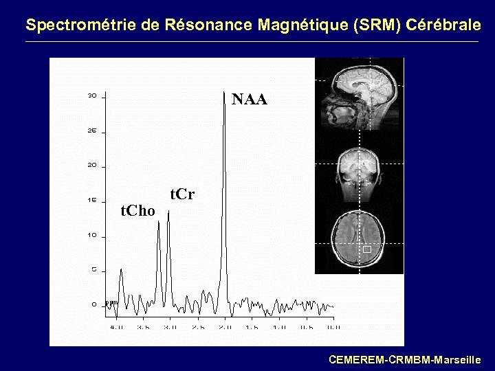 Spectrométrie de Résonance Magnétique (SRM) Cérébrale NAA t. Cho t. Cr CEMEREM-CRMBM-Marseille 