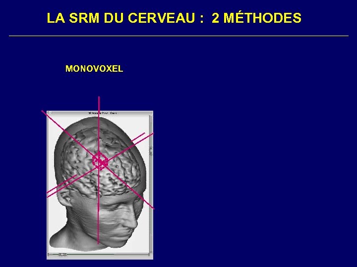 LA SRM DU CERVEAU : 2 MÉTHODES MONOVOXEL 