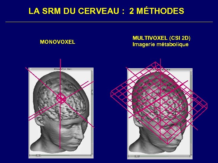 LA SRM DU CERVEAU : 2 MÉTHODES MONOVOXEL MULTIVOXEL (CSI 2 D) MULTIVOXEL Imagerie