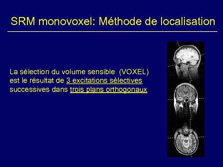 SRM monovoxel: Méthode de localisation La sélection du volume sensible (VOXEL) est le résultat