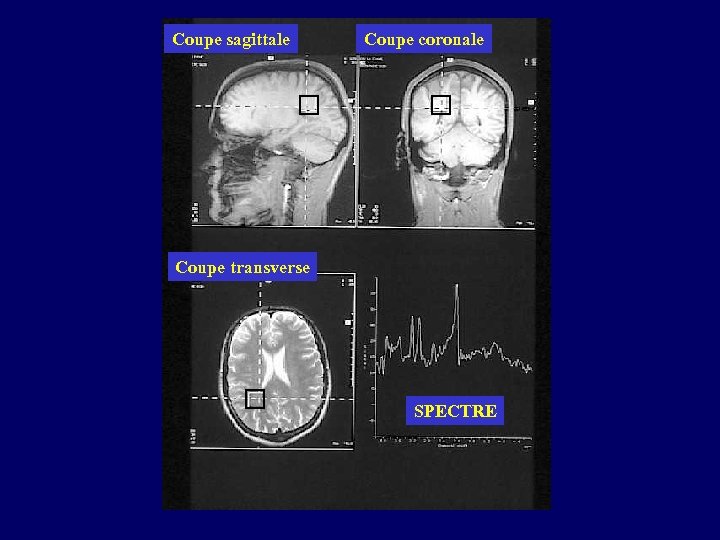 Coupe sagittale Coupe coronale Coupe transverse SPECTRE 