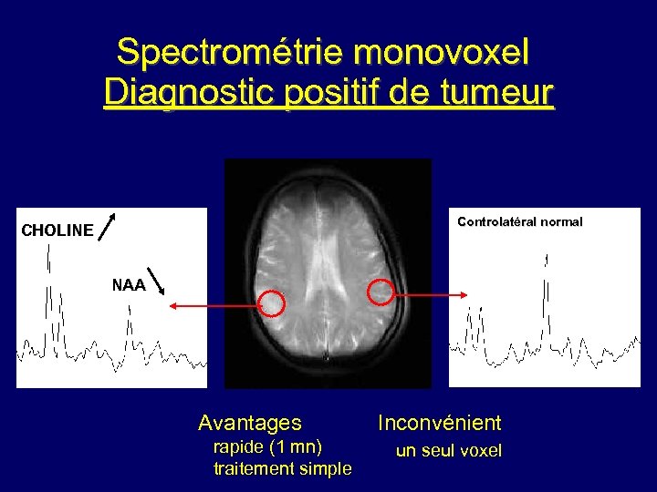 Spectrométrie monovoxel Diagnostic positif de tumeur Controlatéral normal CHOLINE NAA Avantages rapide (1 mn)