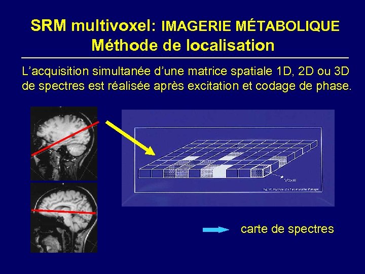 SRM multivoxel: IMAGERIE MÉTABOLIQUE Méthode de localisation L’acquisition simultanée d’une matrice spatiale 1 D,