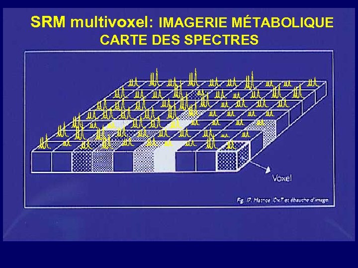 SRM multivoxel: IMAGERIE MÉTABOLIQUE CARTE DES SPECTRES 