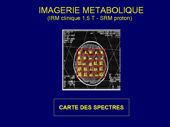 IMAGERIE METABOLIQUE (IRM clinique 1, 5 T - SRM proton) CARTE DES SPECTRES 