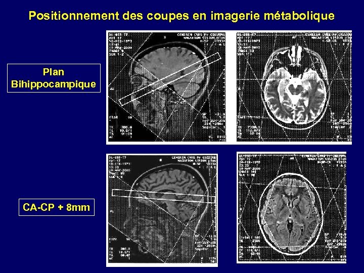 Positionnement des coupes en imagerie métabolique Plan Bihippocampique CA-CP + 8 mm 