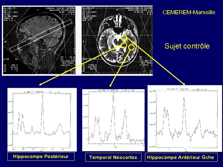 CEMEREM-Marseille Sujet contrôle Hippocampe Postérieur Temporal Néocortex Hippocampe Antérieur Gche 