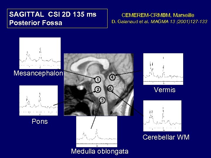 SAGITTAL CSI 2 D 135 ms Posterior Fossa CEMEREM-CRMBM, Marseille D. Galanaud et al.
