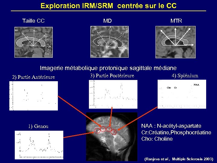 Exploration IRM/SRM centrée sur le CC Taille CC MD MTR Imagerie métabolique protonique sagittale