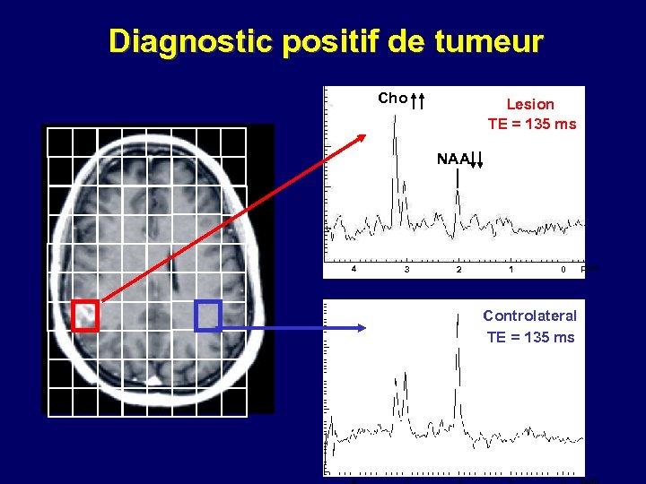 Diagnostic positif de tumeur Cho Lesion TE = 135 ms NAA 4 3 2