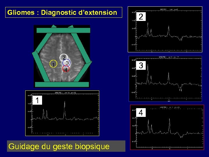 Gliomes : Diagnostic d’extension 2 2 1 3 4 3 1 4 Guidage du