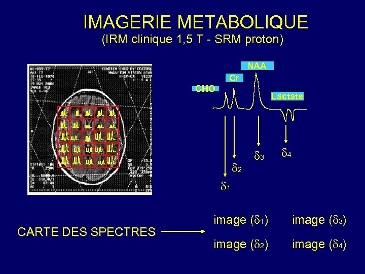 IMAGERIE METABOLIQUE (IRM clinique 1, 5 T - SRM proton) NAA Cr CHO Lactate