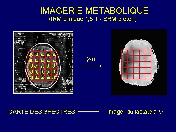 IMAGERIE METABOLIQUE (IRM clinique 1, 5 T - SRM proton) ( 4) CARTE DES