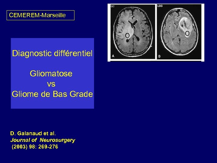 CEMEREM-Marseille Diagnostic différentiel Gliomatose vs Gliome de Bas Grade D. Galanaud et al. Journal