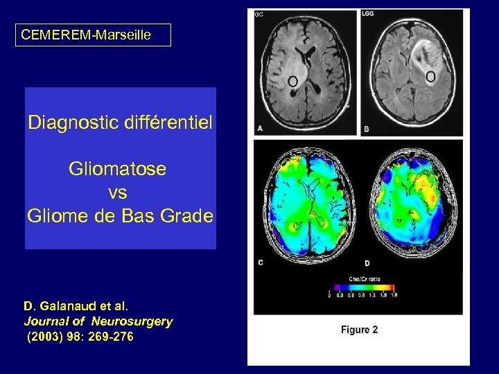 CEMEREM-Marseille Diagnostic différentiel Gliomatose vs Gliome de Bas Grade D. Galanaud et al. Journal