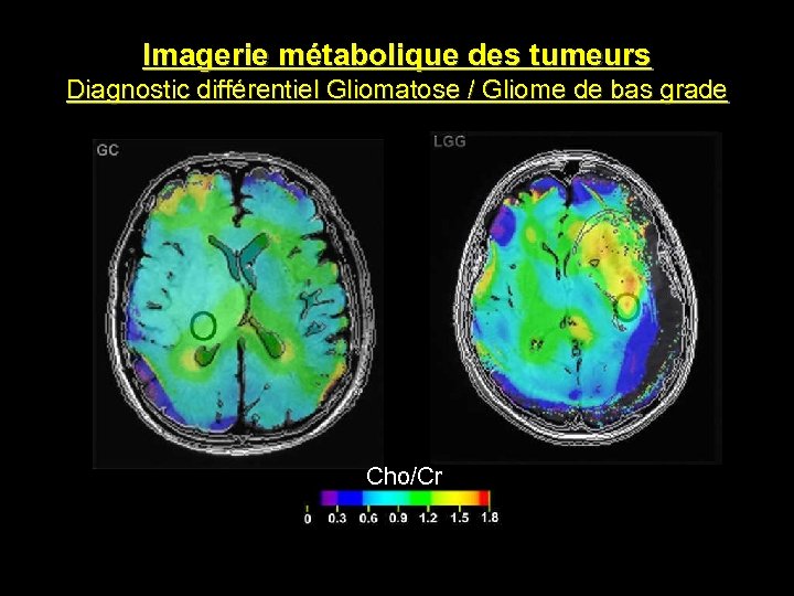 Imagerie métabolique des tumeurs Diagnostic différentiel Gliomatose / Gliome de bas grade Cho/Cr 
