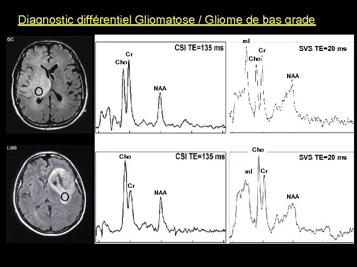 Diagnostic différentiel Gliomatose / Gliome de bas grade m. I Cr Cho SVS TE=20