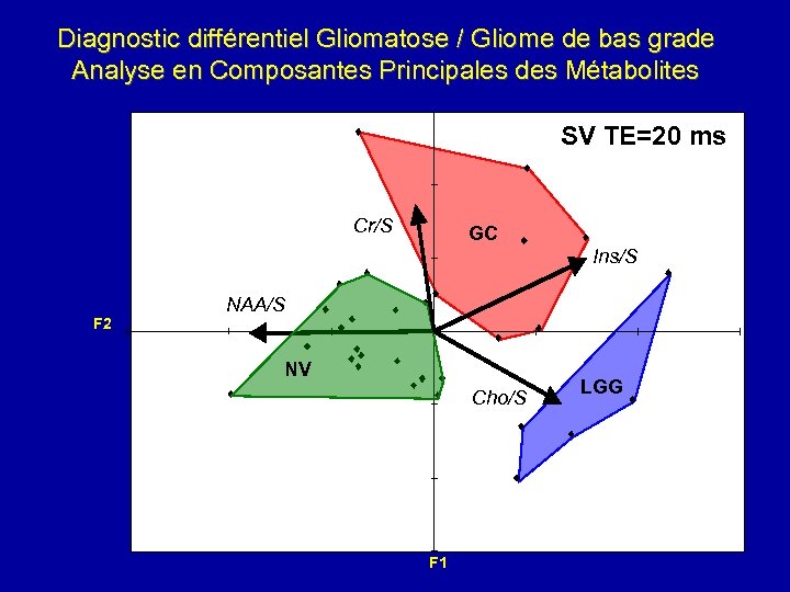 Diagnostic différentiel Gliomatose / Gliome de bas grade Analyse en Composantes Principales des Métabolites