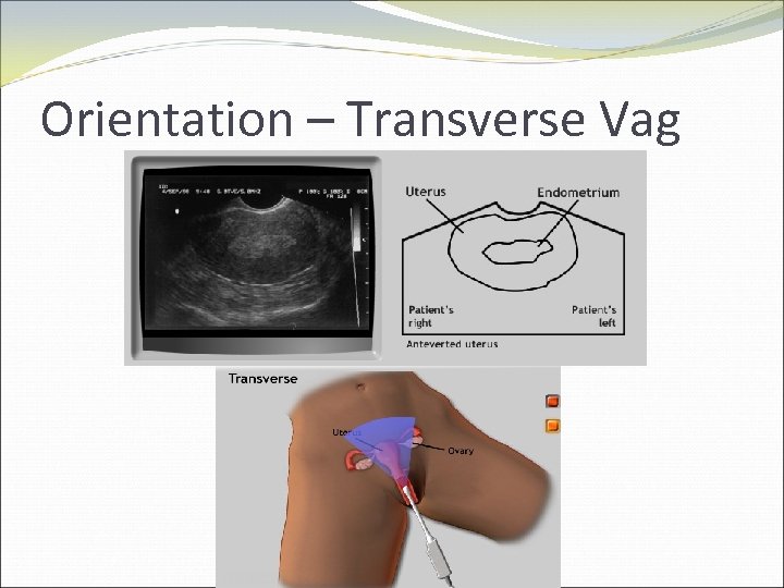 Orientation – Transverse Vag 