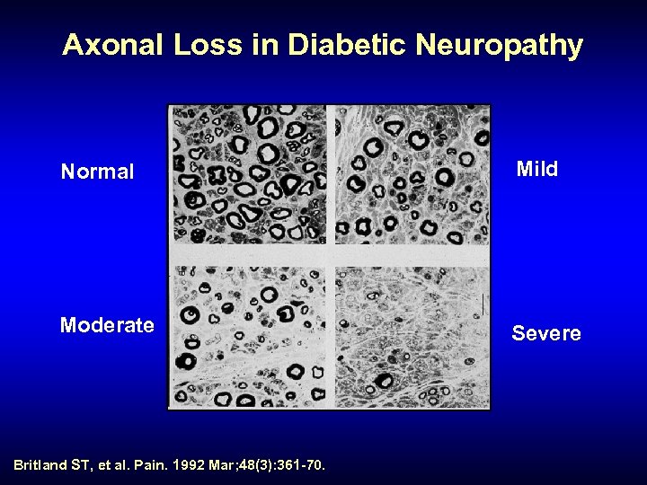 Axonal Loss in Diabetic Neuropathy Normal Mild Moderate Severe Britland ST, et al. Pain.