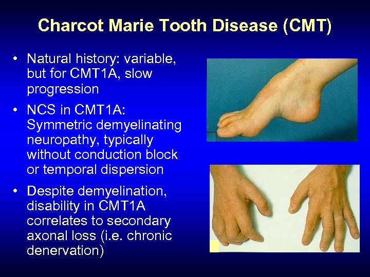 Charcot Marie Tooth Disease (CMT) • Natural history: variable, but for CMT 1 A,